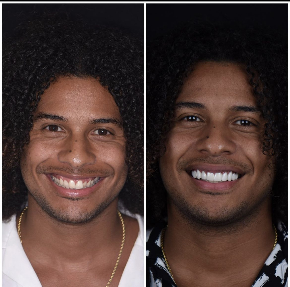 Anterior refinement · Natural translucency — before and after