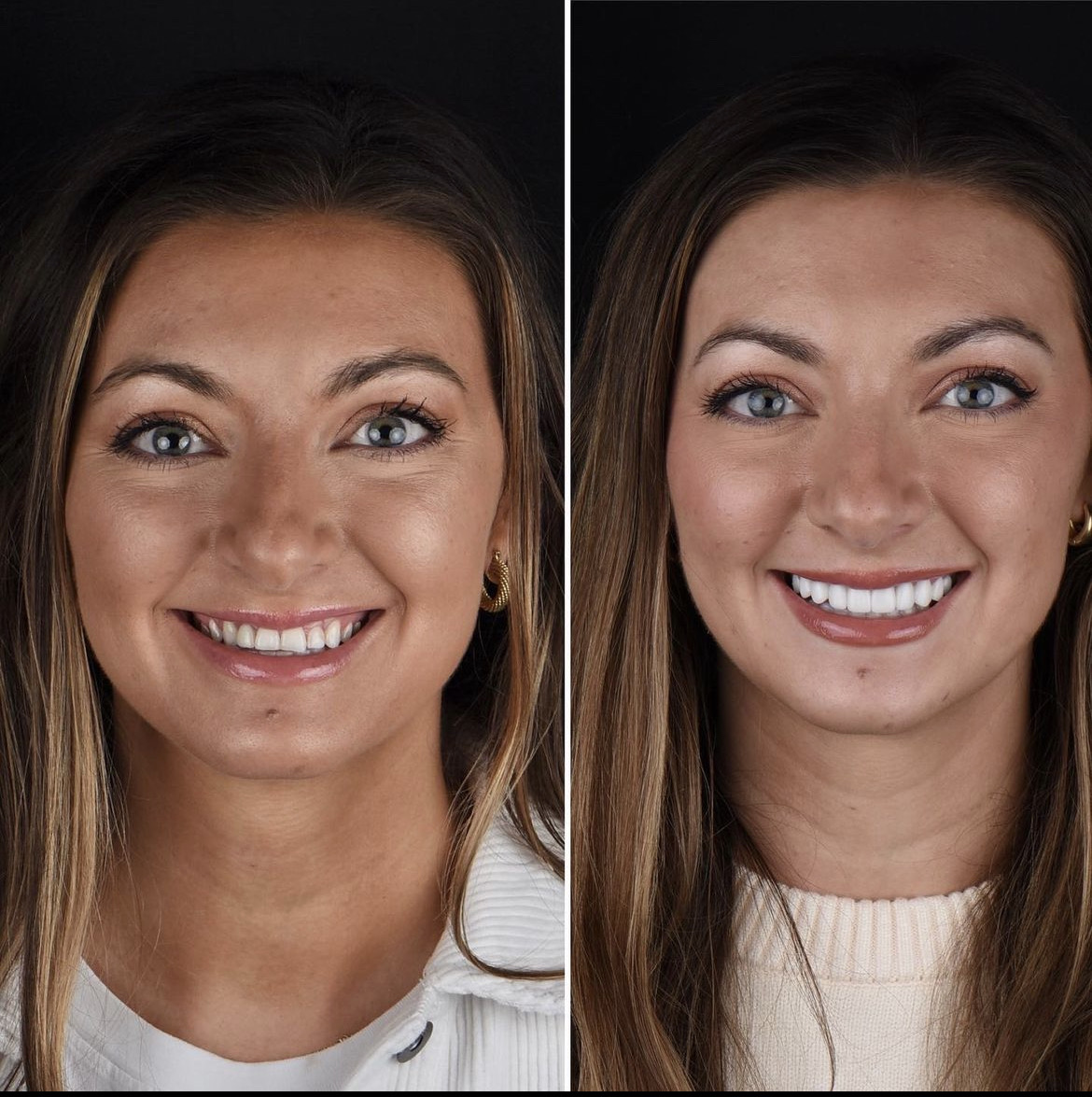 Upper ten · Youthful shape — before and after