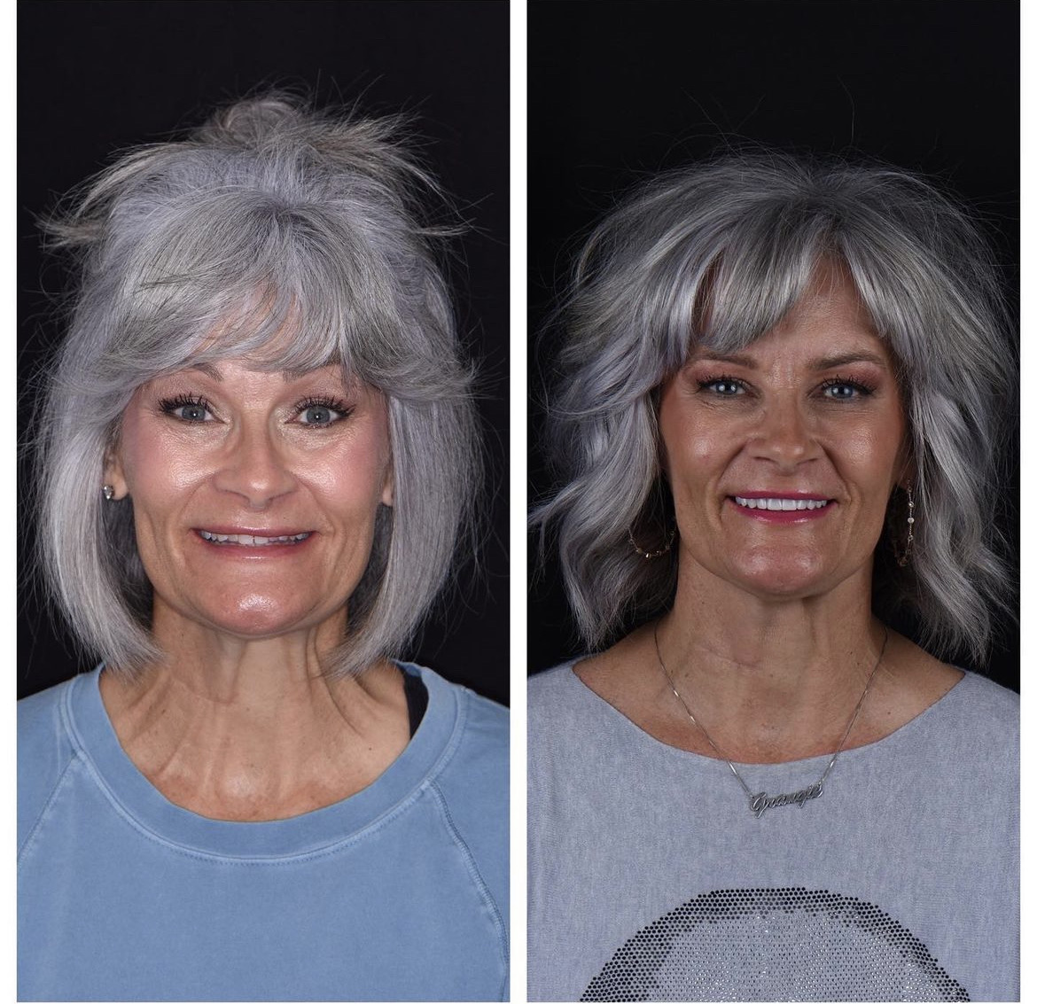 Mature smile · Rejuvenation — before and after