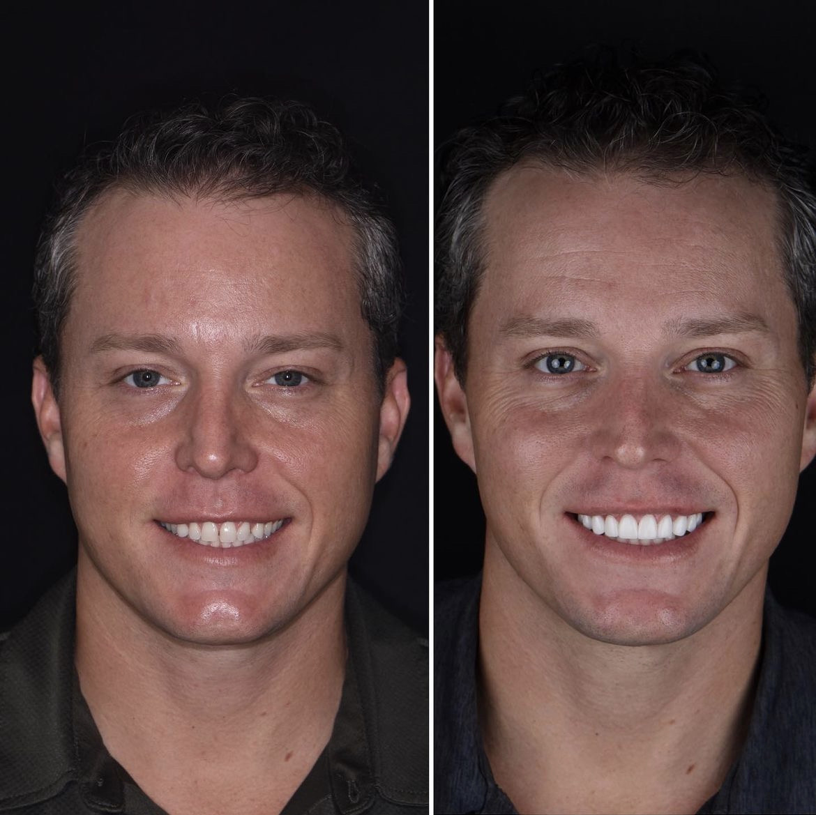 Full arch · Complete smile design — before and after