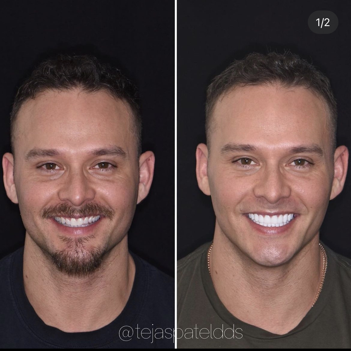 Refined masculine smile — before and after
